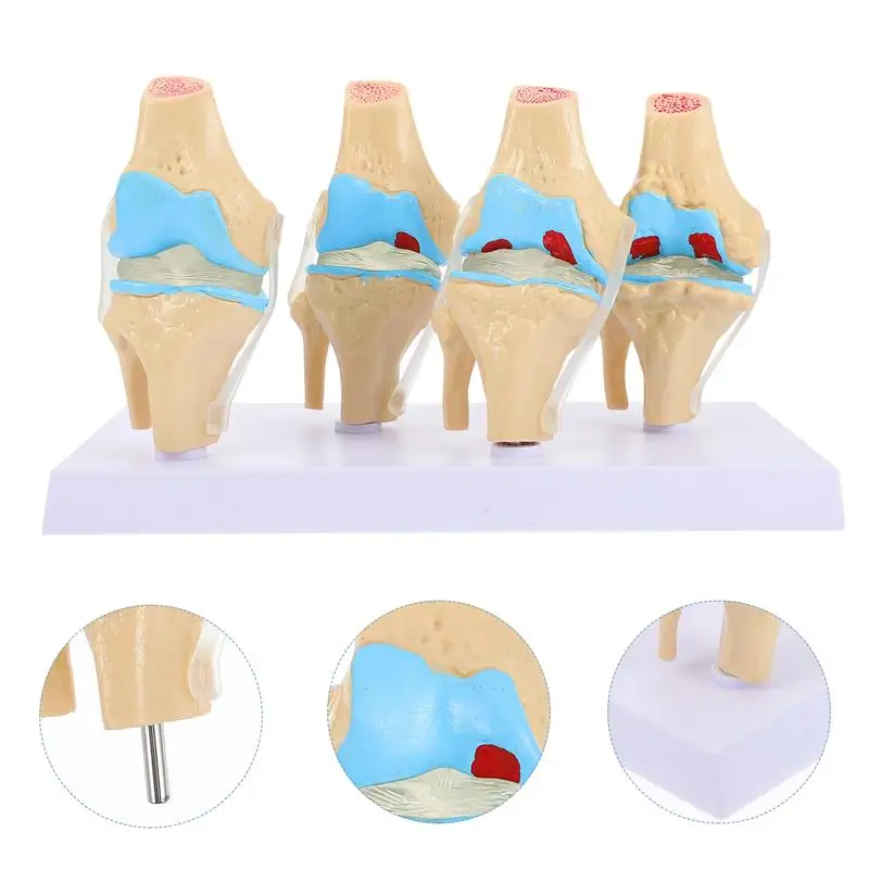 

Human Pathological Knee Joint Model Pathological Knee Joint Display Model