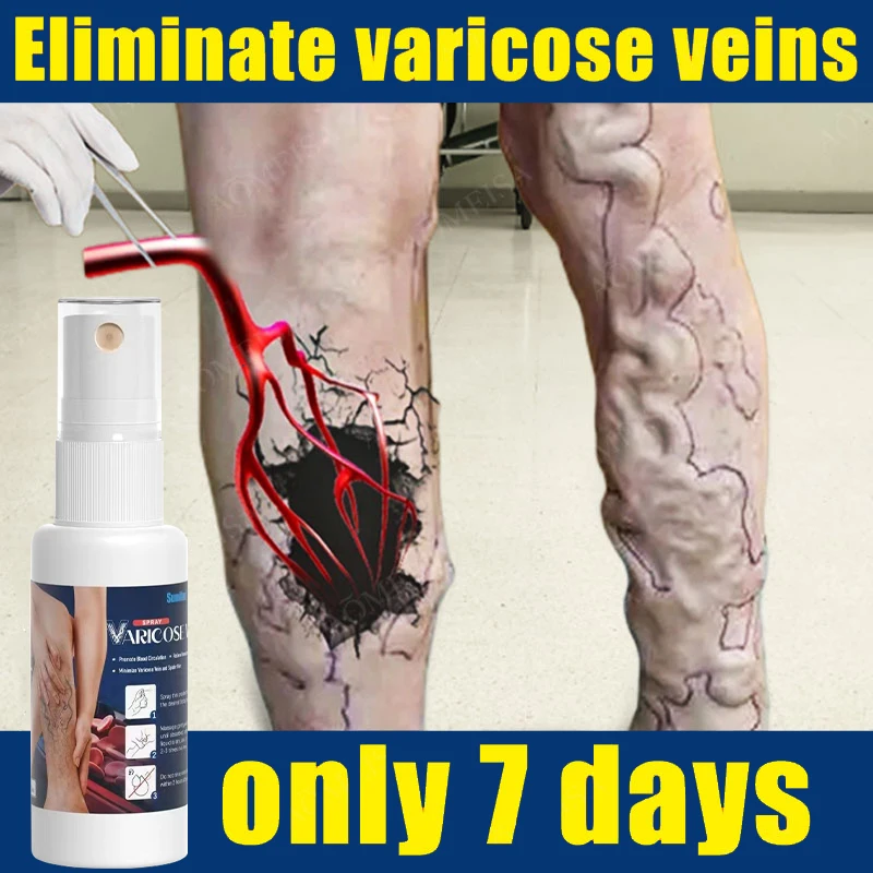 

Effective Varicose Vein Relief Cream Ointment For Varicose Veins To Relieve Vasculitis Phlebitis Spider Pain Treatment
