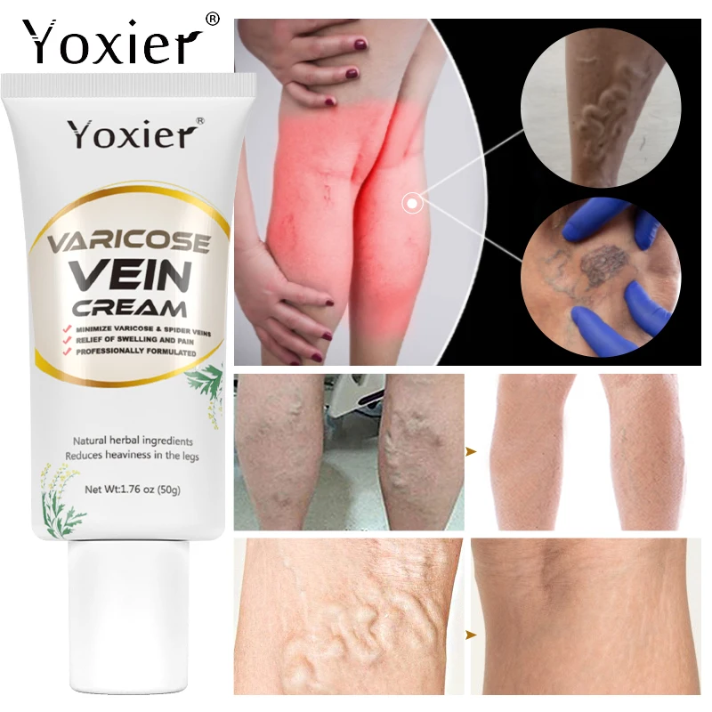 Крем от варикозного расширения вен улучшение васкулита флебит облегчение боли в