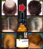 hot sale hair growth essential oils ginger germinal oil fast treatment hair loss serum beauty growth dense growth anti hair 30ml