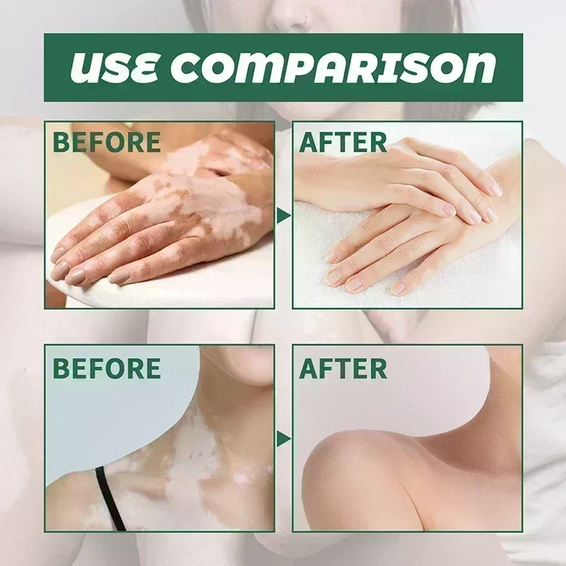 Удаление белых точек на коже Vitiligo устранение уход за кожей тела