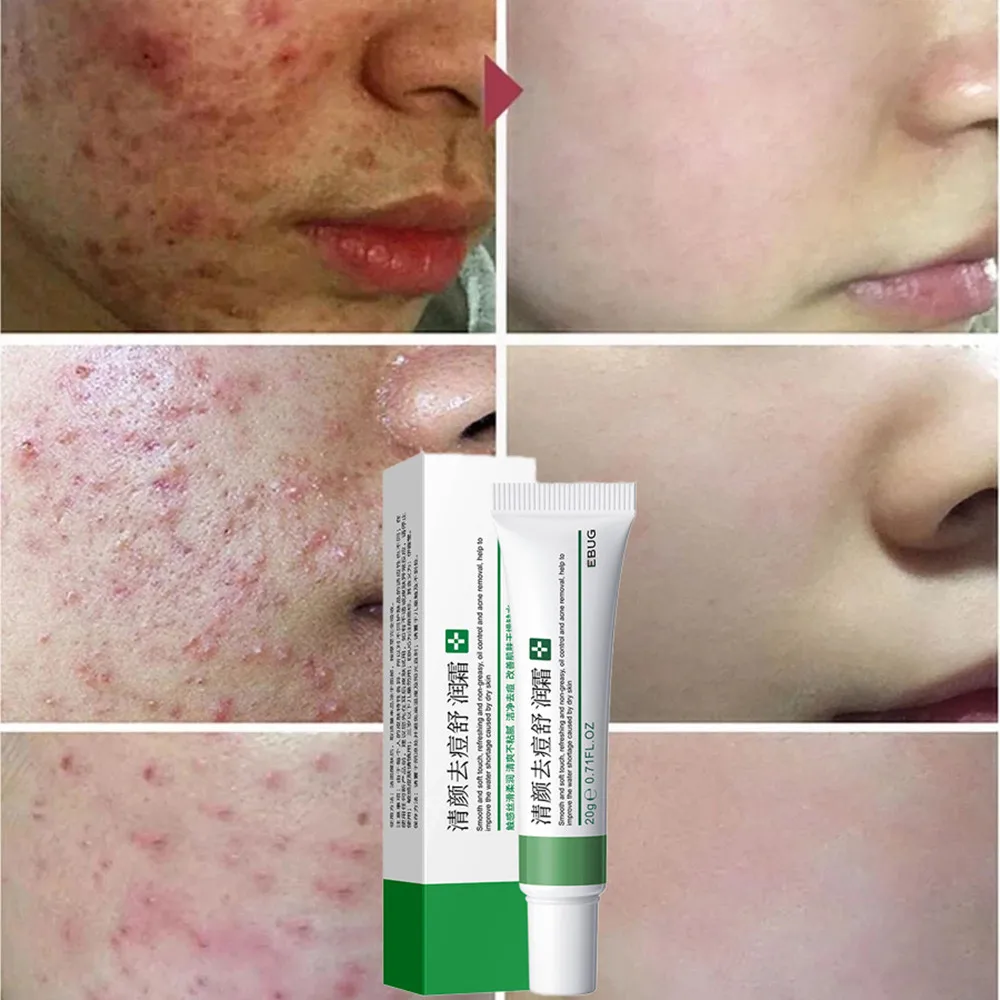 

20g Effective Acne Removal Cream Acne Treatment Fade Acne Spots Oil Control Shrink Pores Whitening Moisturizing Acne Cream