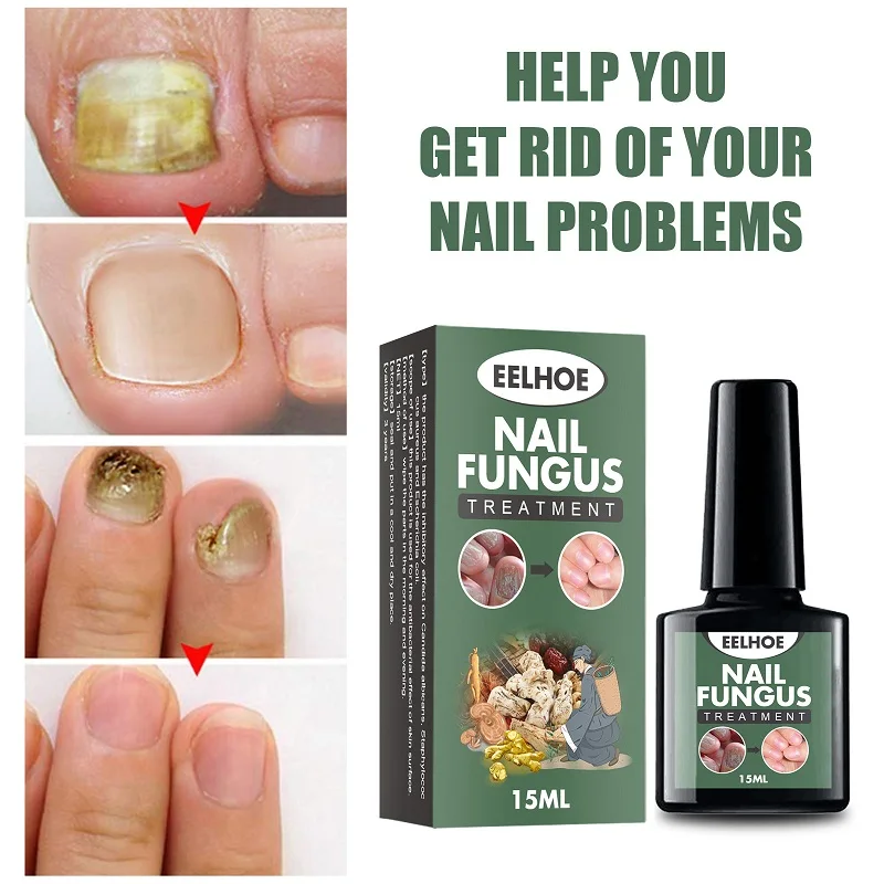 Herbal Nail Fungus Repair Essence Fungal Treatment Hand Feet Toe Nail Fungus Removal Gel Anti Infection Paronychia Onychomycosis