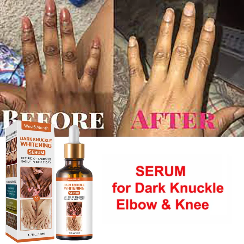 

Dark Kunckle Whitening Serum Strong Whitening Serum for Dark Knuckle Fingel for Removing Dark Knuckle Elbow and Knee 50ml