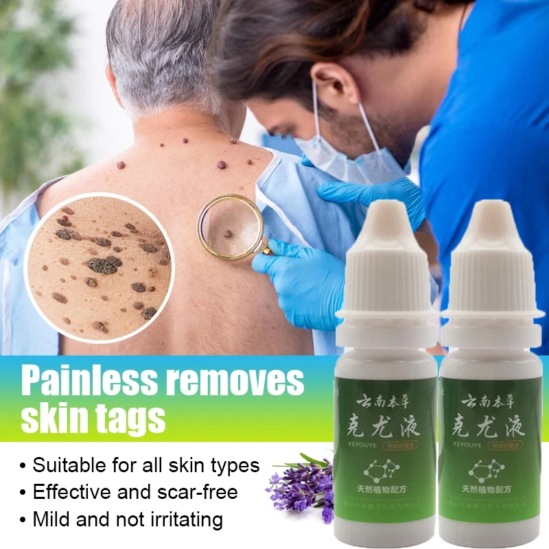 

2pcs Wart Removing Liquid Papillomas Removal Genital Warts Liquid From Skin Tags Against Moles Body Repair Dressing 10ml