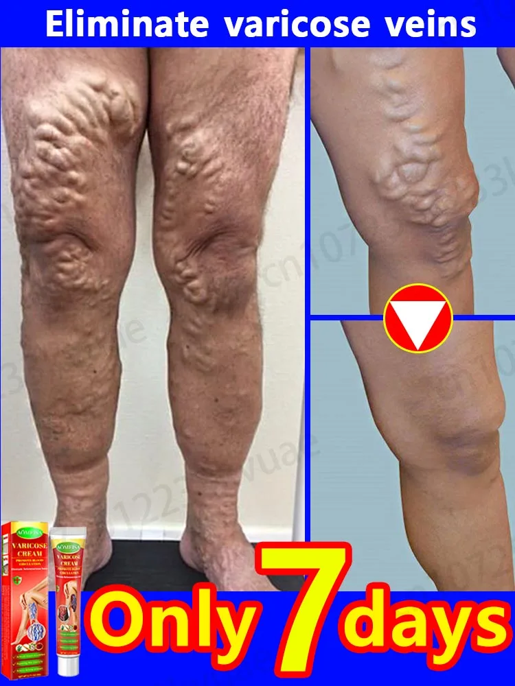 

Мазь для лечения варикозного расширения вен эффективный крем для облегчения варикозного расширения вен для облегчения васкулит флебит паук лечение боли