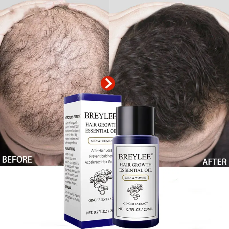 

BREYLEE Ginger Hair Growth Essential Oil Anti Hair Loss Fast Grow Serum Repair Dry Frizzy Damaged Nourish Scalp Treatments 20ML