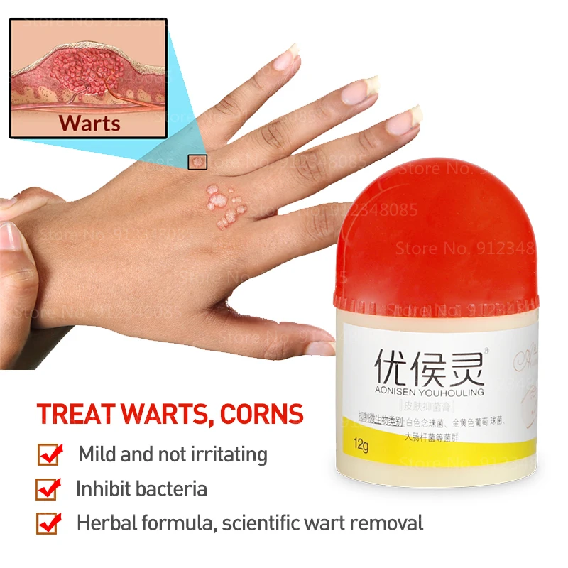 

Крем для лечения бородавок на теле, мазь для ухода за кожей, средство для удаления бородавок на ногах, 100% травяная медицина, мазь для удалени...