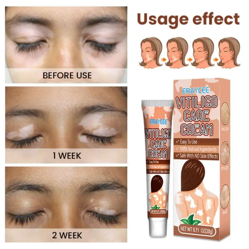 

1/3/5/10PCS White Spot Cream Pigment Melanin Promoting Liniment Skin Vitiligo Leukoplakia Disease TreatmentS Plaster