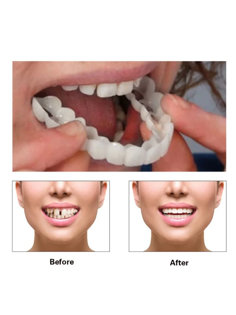 Dentier Sourire Fausse Dents Facette Dentaire Couvre Dents Artificielles  Dentier Amovible Haut et Bas Prothèses Réutilisable Dentaires Snap on Fit  Flex Facettes Dents Placages : : Hygiène et Santé