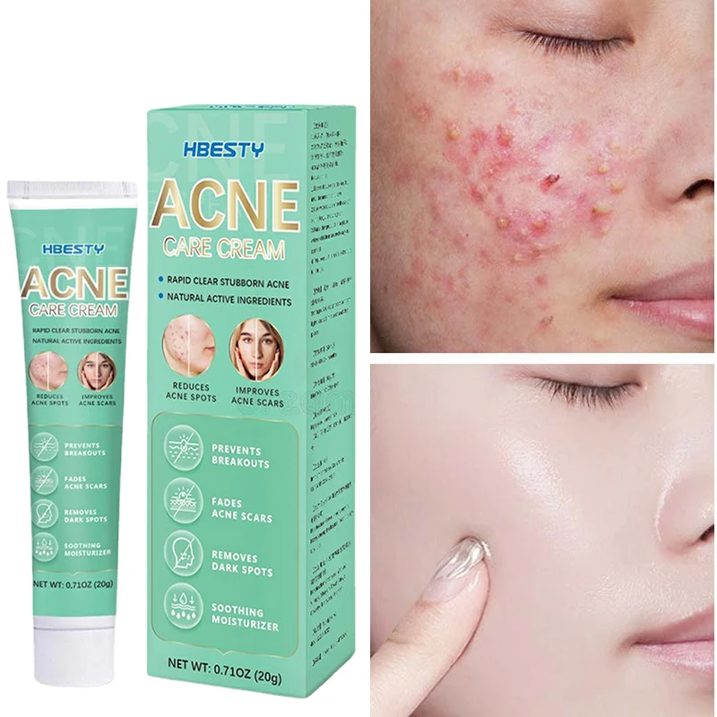 Anti Acne Treatment Pimple Dark Spot Face Acne Scar Removal Creme ​Moisturizing Brighten Skin Tone Korean Skin Care Cosmetics 20