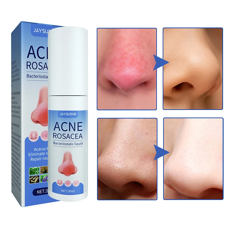 

Rosacea Tea Tree Essential Oils Blackheads Pimple Dead Skin Remover Repair Serum Shrink Pores Deep Cleaning Nasal Skin Care