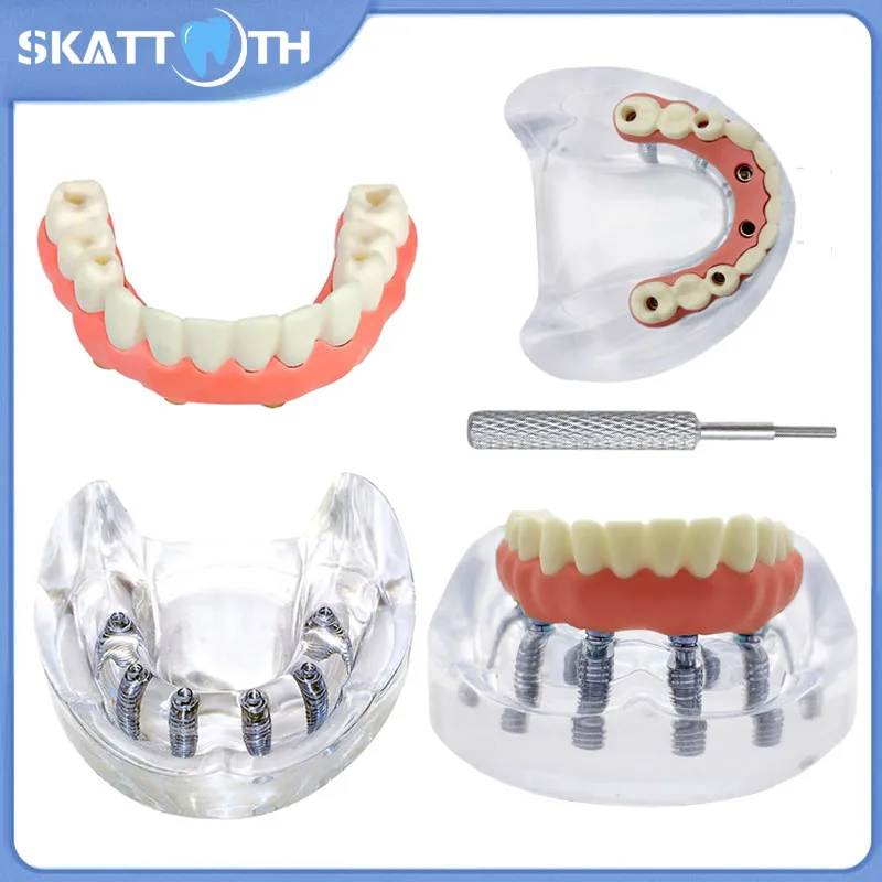 1 шт. модель зубного имплантата 6 имплантатов реставрация зубов стоматолог