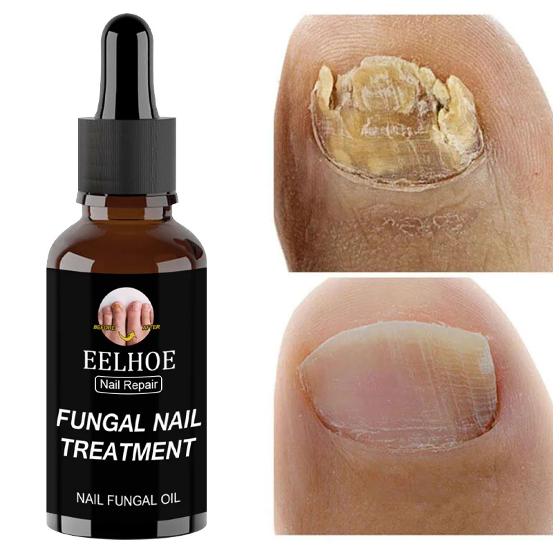 

Fungal Nail Treatment Serum Cuticle Nourishing Oil Foot Fungus Remedy Repair Toe Nails Care Products Anti Infectio Onychomycosis