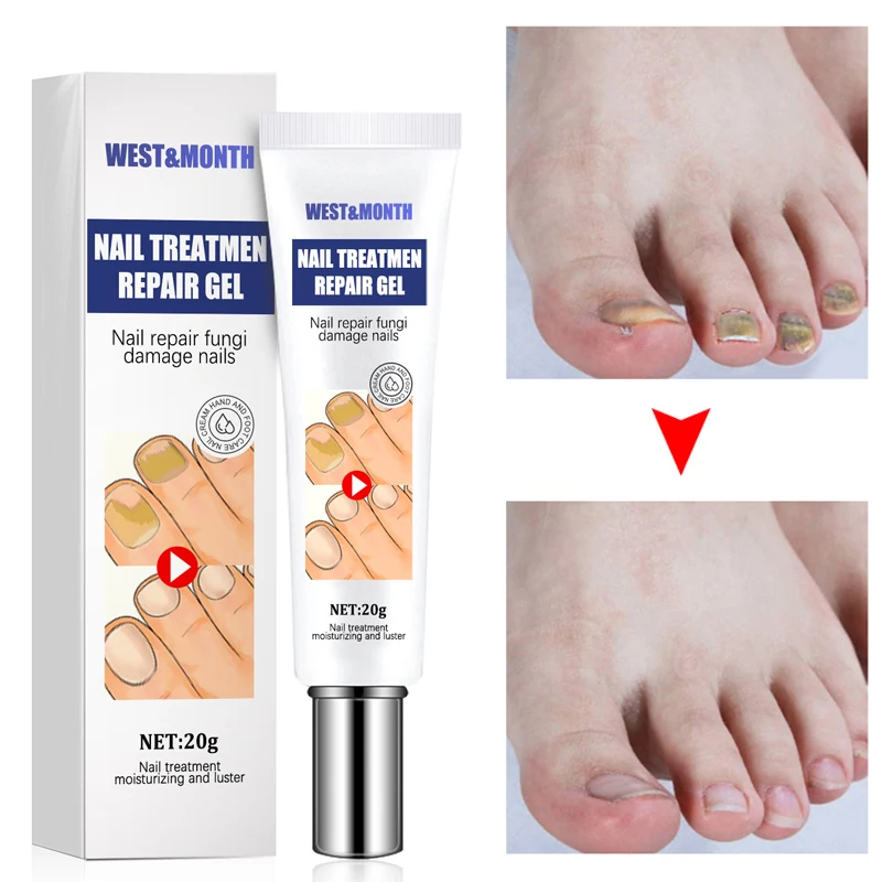 

Nail Fungus Treatment Cream Toe Fungus Hand Foot Removal Anti Infection Gel Nourishing Repair Paronychia Onychomycosis Products