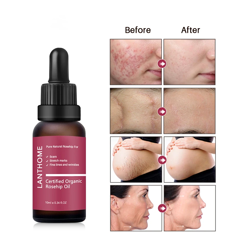 

Rosehip Oil Organic Moisturizer Anti-Aging Essential Oil Reduces Scars Fine Lines Wrinkles Stretch Marks Improves Skin Firmness