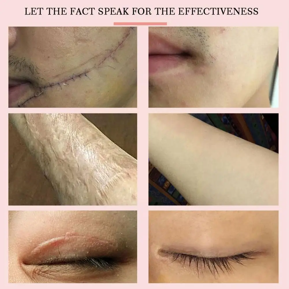 

Lavender Repair Scar Cream Acne Scar Stretch Marks 1pcs Anti-allergic Whitening Calm Care Cream Corrector Pigmentation Face L1q4