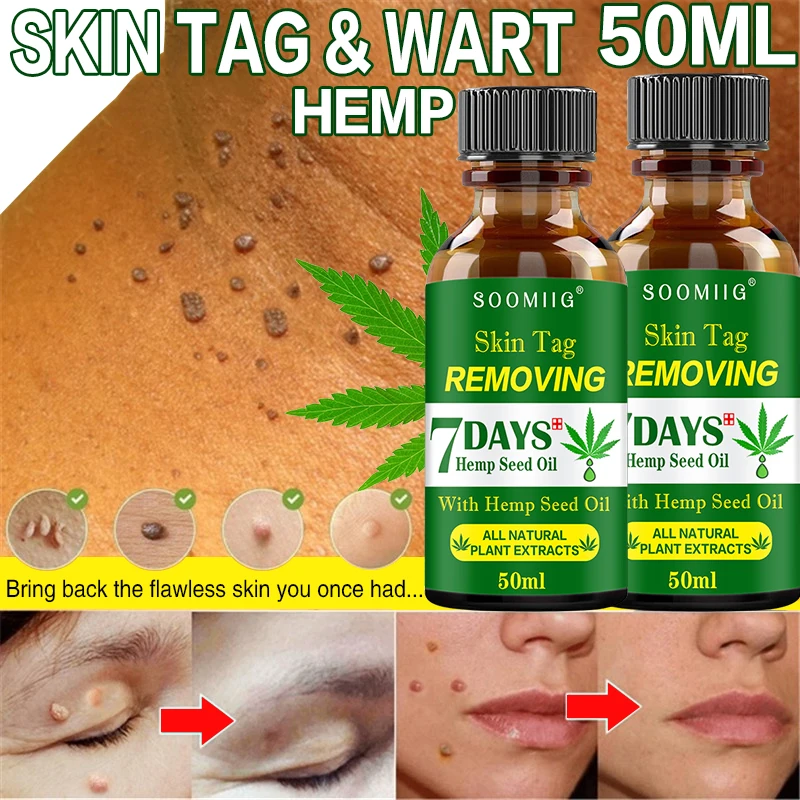 

50mlTreatment Papillomas Removal of Warts Liquid kill Remover Foot Corn Skin Tag Mole &amp Genital Wart Remover Remedy Skin Care