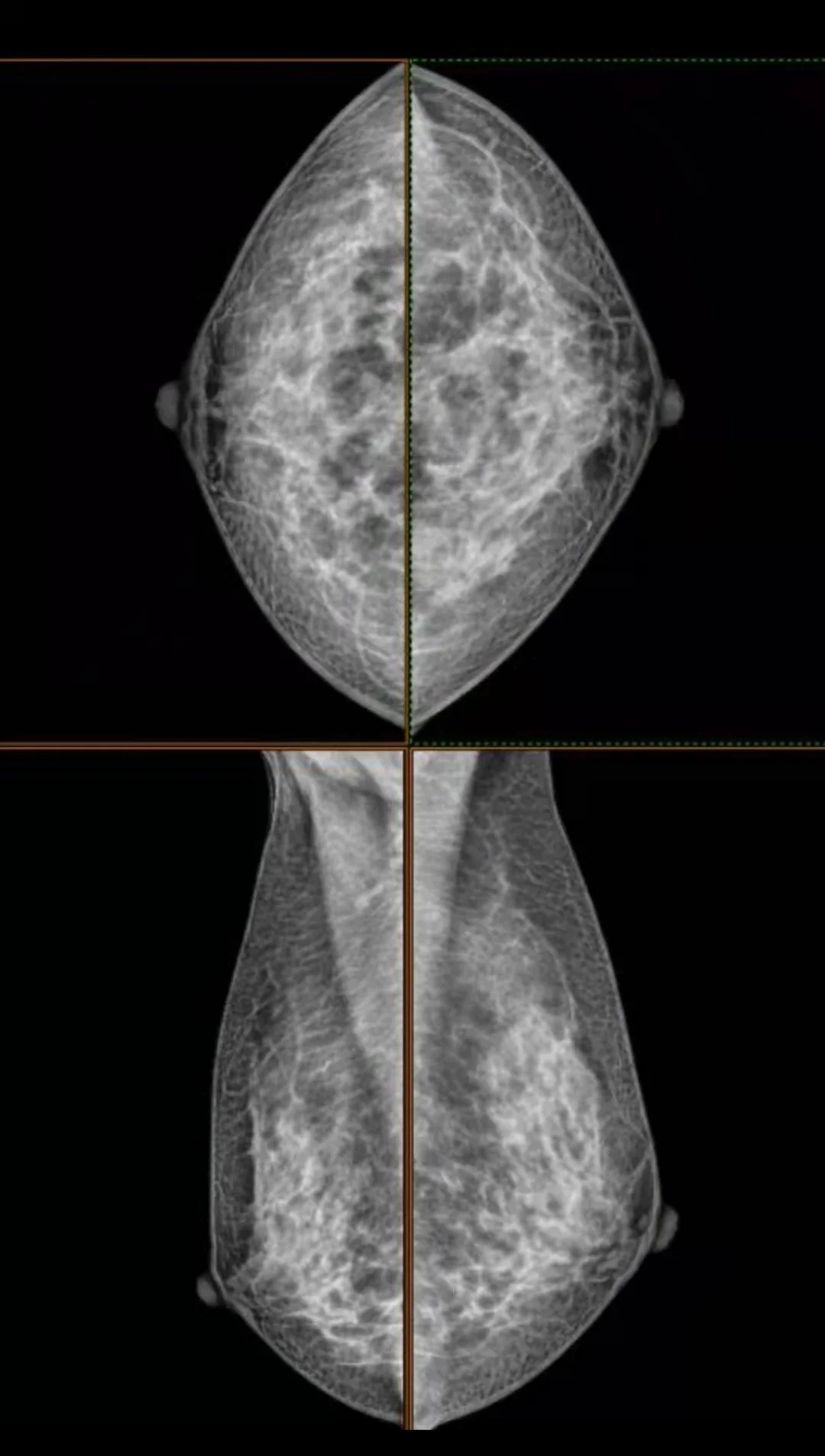 Mammo FPD-1012C 1012C IRAY Кассетный детектор a-Si Mammography с ценой программного обеспечения