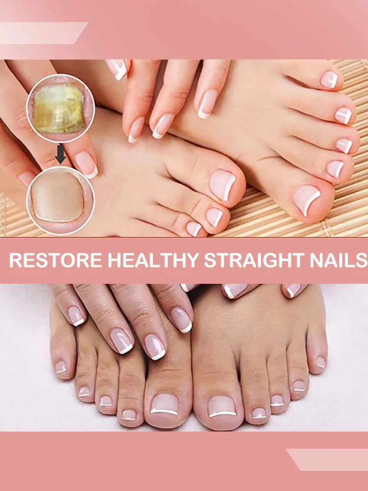 

Nail Fungal Treatment Serum Onychomycosis Paronychia Anti Infection Toe Fungus Hand Foot Removal Repair Gel Care Beauty Health
