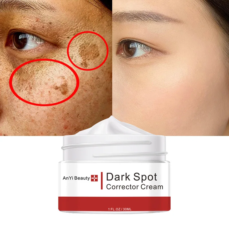 Whitening Freckle Cream Remove Dark Spots Melanin Melasma Moisturizer Brighten Product Fade Acne Scars Anti-Aging Face Skin Care