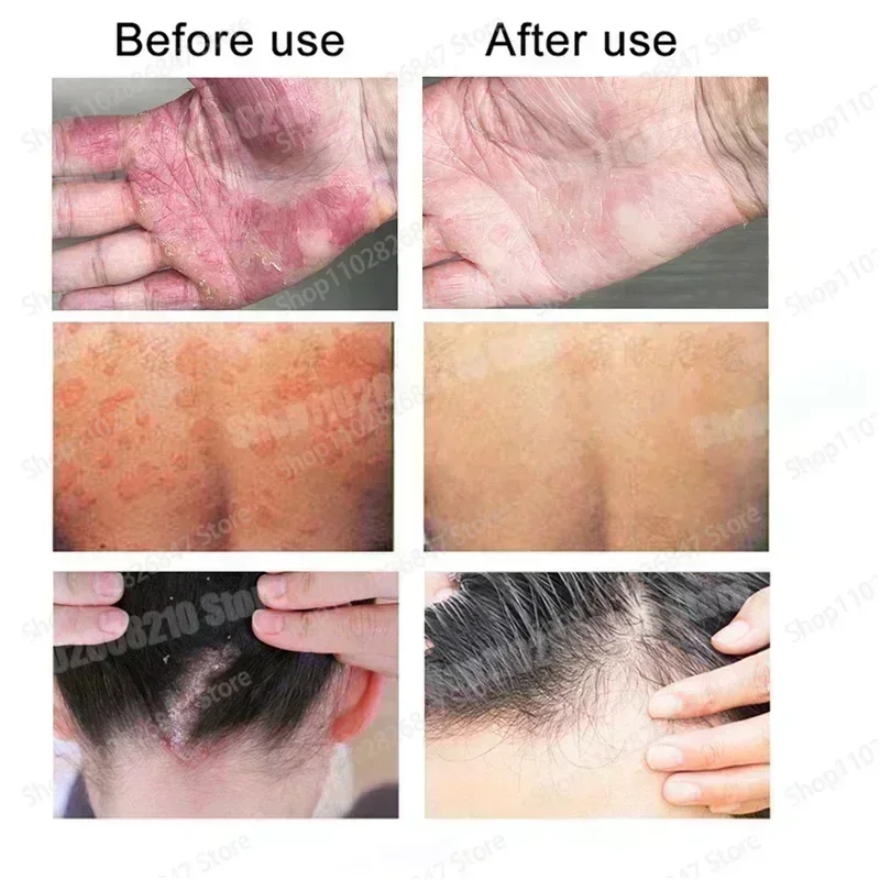 Hot sales Ointment From Psoriasis Work Perfect For Skin Problems Cream Antipruritic Medical Beauty-Health Plaster