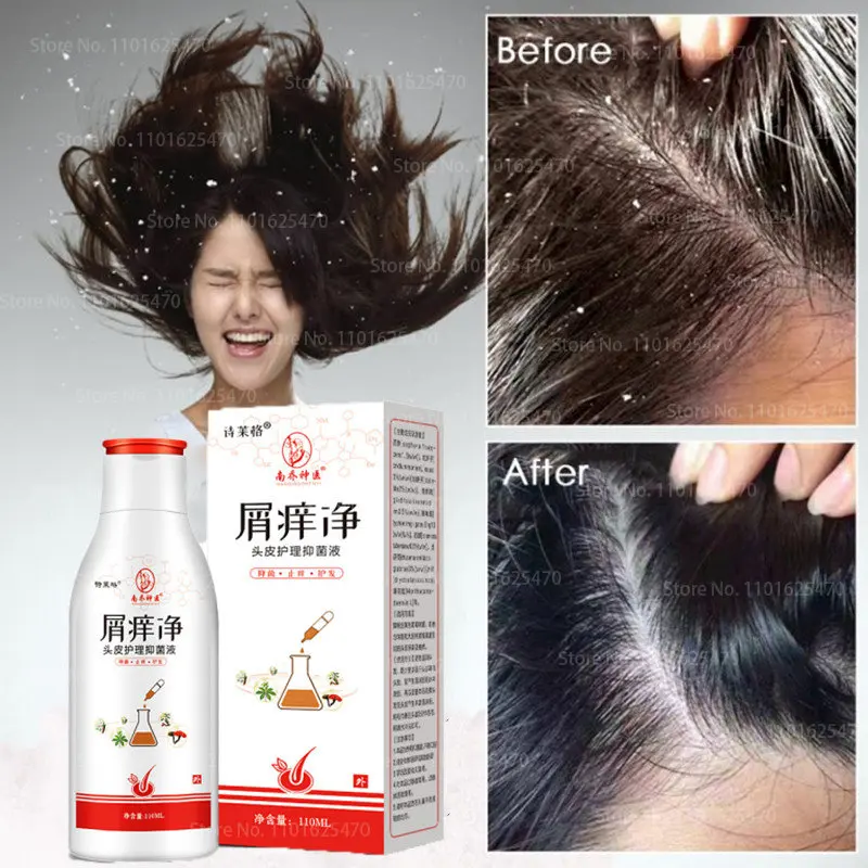 

110ML Natural Plant Mites Shampoo Anti-dandruff Anti-itching Shampoo Scalp Treatment Dermatitis Eczema Herbal Shampoo Hair Care