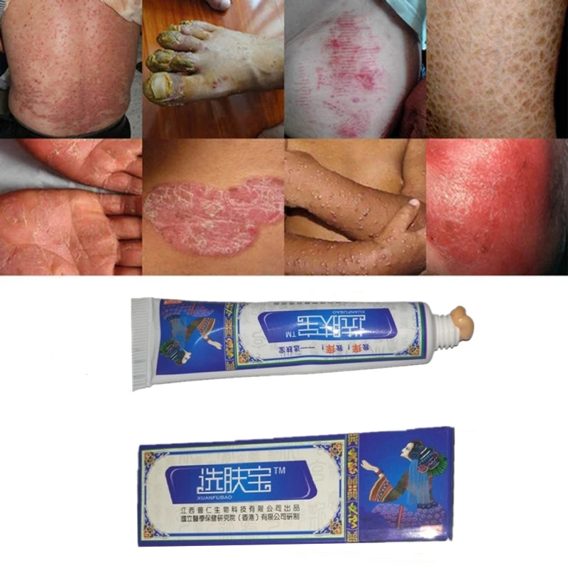 

Psoriasis Cream Dermatitis Eczematoid Eczema Ointment Anti-Itch Sweat Spot Antibacterial Chinese Herb Medical Skin Care Cream