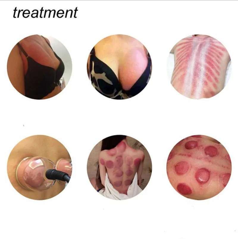 Антицеллюлитный массажный баночный набор присоски машина для вакуумной терапии