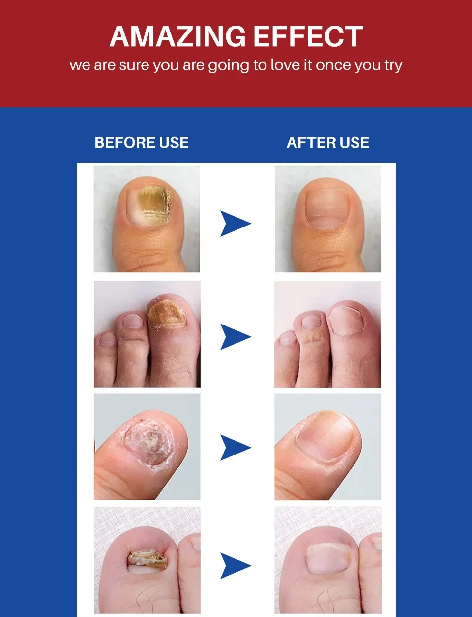 ł do naprawy paznokci Leczenie szarych Pielęgnacja stóp Sterylizacja u Esencja odżywcza Rozwiązanie niewymagające Roztwór leczniczy