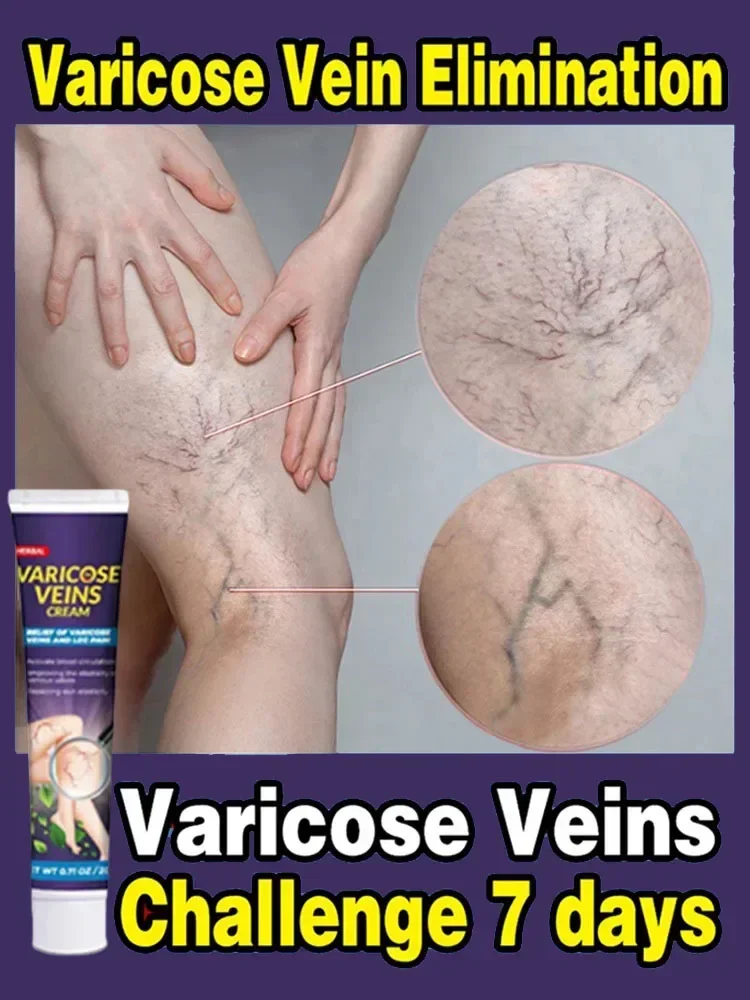 Лечение Варикозного расширения вен облегчение боли в ногах васкулит флебит паук - Цена: 16790