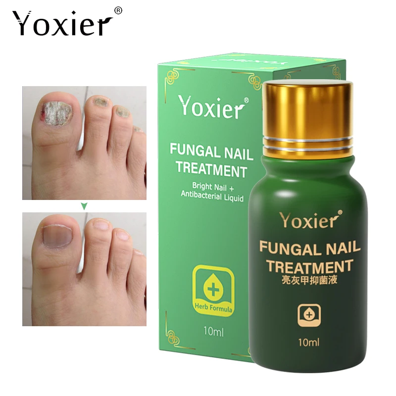 Сыворотка для лечения грибка ногтей антиинфекционное удаление онихомикоза
