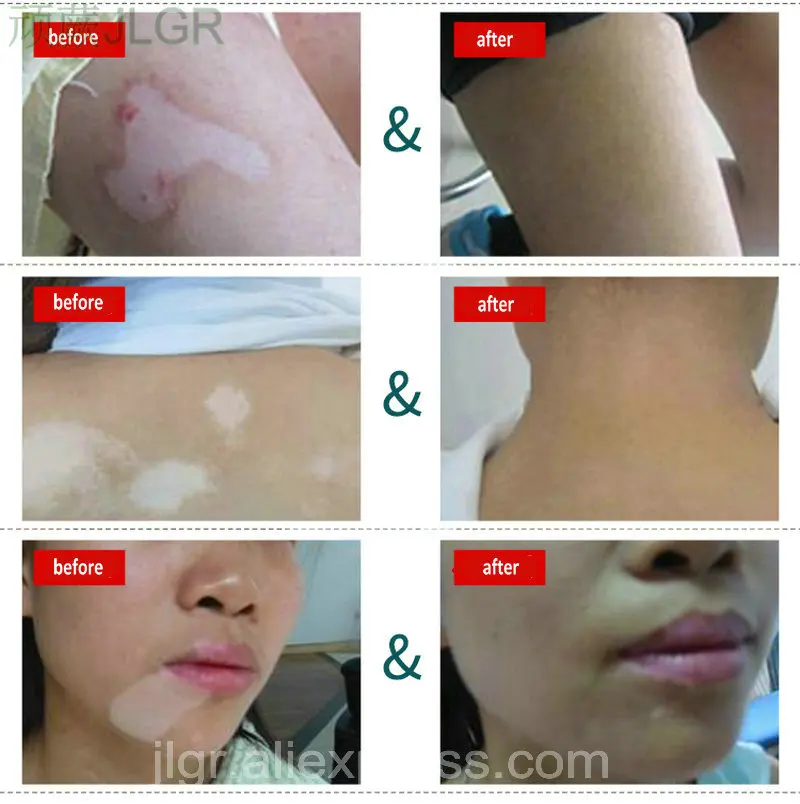

Chinese Medical Professional Treatment For Skin White Spot Vitiligo Eczema Sweatstain Net health Care Solution repair melanin