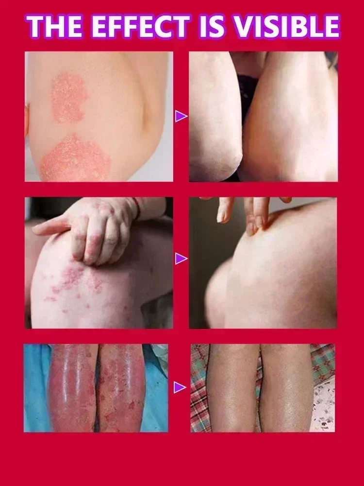 Устройство для избавления от псориаза лучше всего использовать в соответствии с