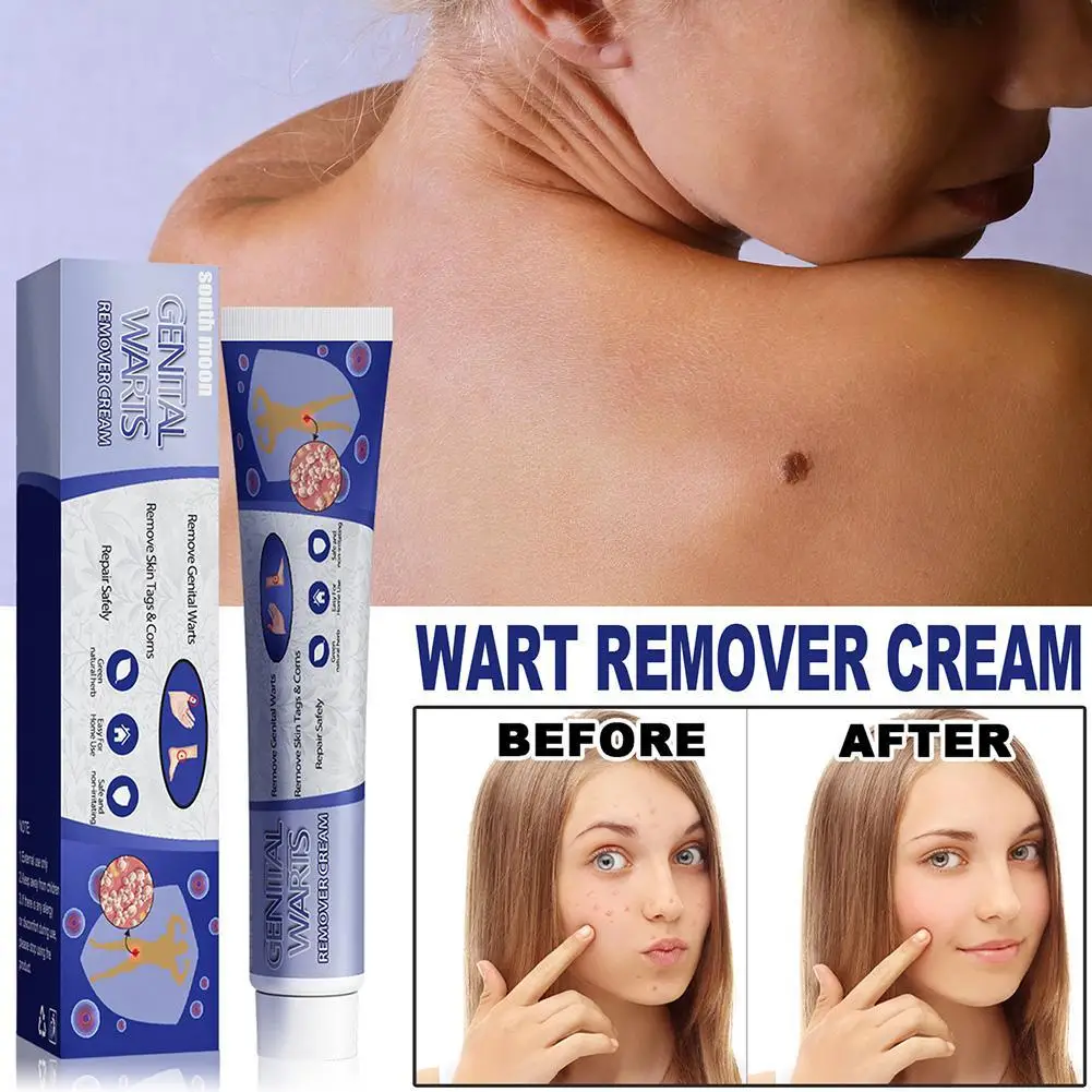 

20g Warts Remover Ointment Cream Skin Tags Removal Gel Body Health Care Mole Remover Wart Removal Body Warts Treatment