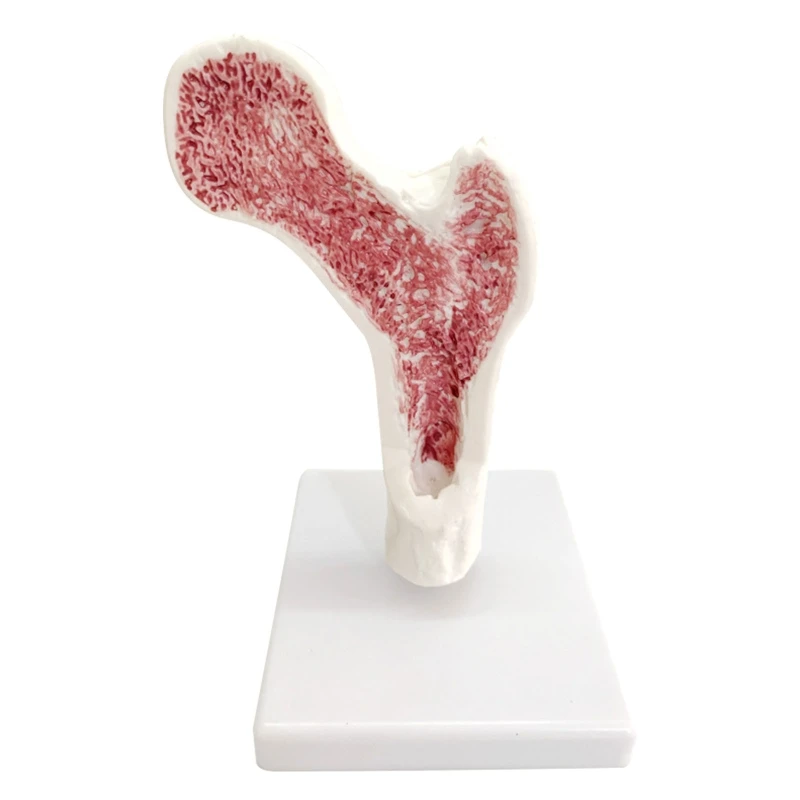 

Osteoporosis Femur Leg Bone Model Femur Disease Model with Base Removable for Medical Teaching Aids Patient Education