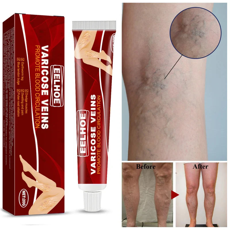 

Varicose Veins Treatment Cream Relieve Legs Tired Dilated Vasculitis Phlebitis Spider Pain Relief Ointment Medical Body Plaster