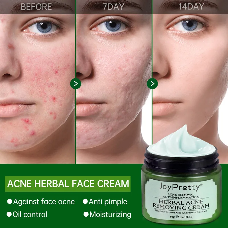 

Herbal Acne Treatment Cream Pimples Scar Spot Removal Facial Cream Oil Control Shrink Pores Skin Care Beauty Health Cosmetic 50G