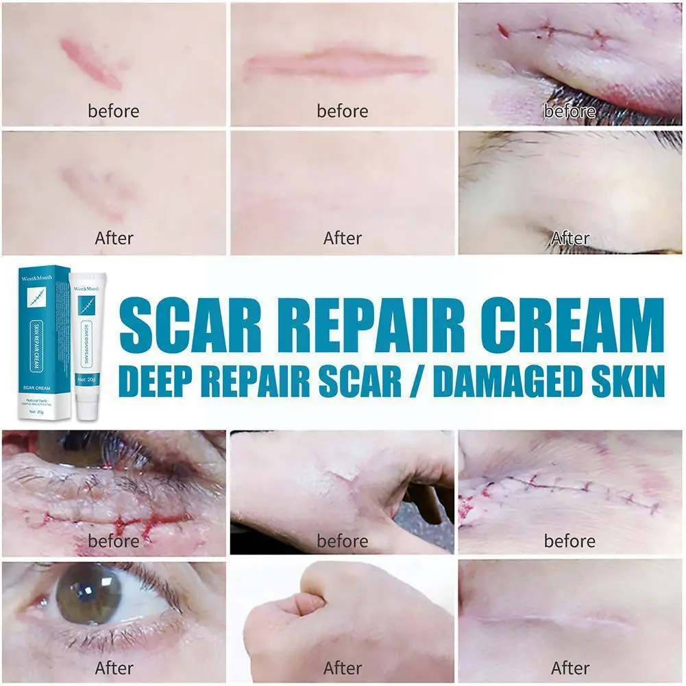 

20g Acne Scar Removal Cream Repair Burn Surgical Scars Smoothing Regeneration Enhance Skin Stretch ​promote Marks Cell Body W9i9