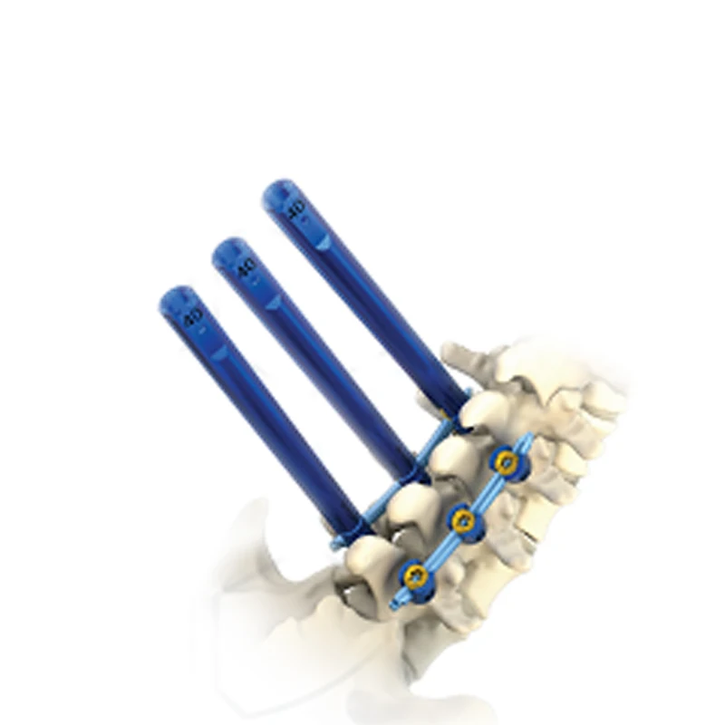 

Meditech Factory Price Orthopedic Surgical Implants 5.5 Minimally Invasive Screw for Spine Surgery