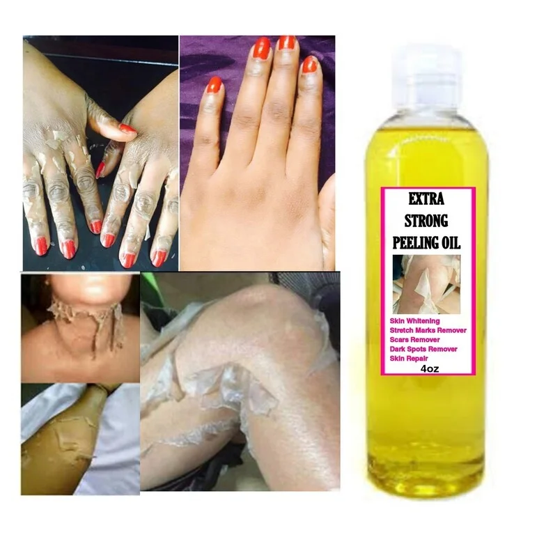 

Yellow Peeling Oil Bleaching Dark Skin Spots Blackheads Blemishes Bad Skin Spot Treatment Extra Strong Whitening Peeling Oil