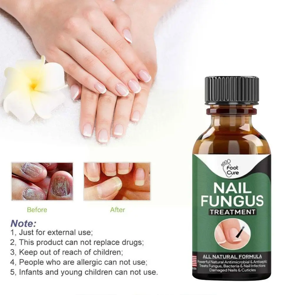 

30ml Fungal Nail Repair Essence Serum Care Treatment Toenail Fungus G4d6