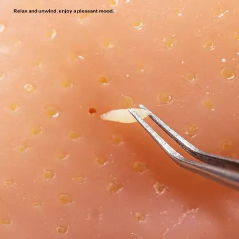 Силиконовая игрушка от прыщей ZTOYL