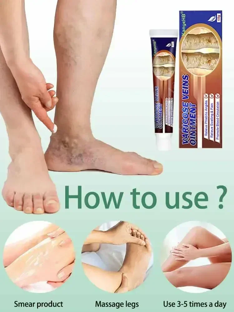 Фотоаппарат для лечения варикозного ангиита удаления отеков и боли в бедре