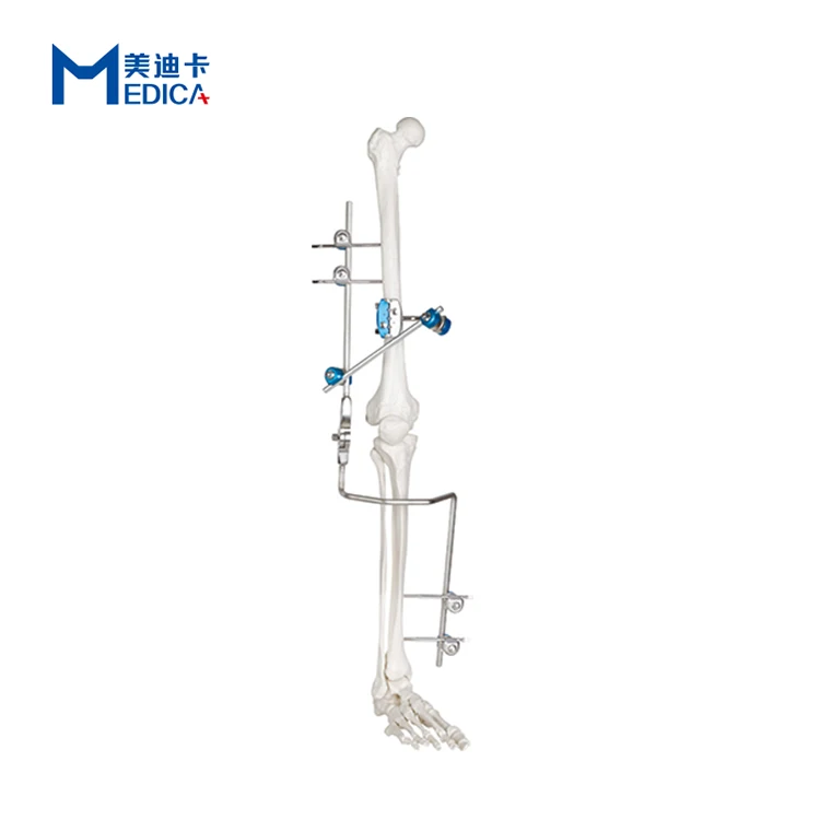 

hoffman external fixator orthopedic instruments stryker for radius Surgical fixation set knee joint