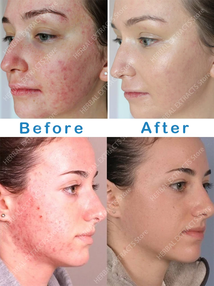 

Acne Removal Whitening Cream Effective Fade Acne Spots Repair Gel Oil Control Moisturizing Shrink Pores Acne Treatment Skin Care