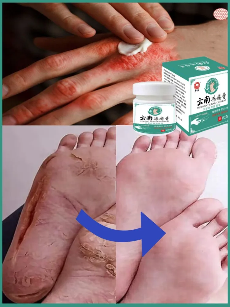 

Herbs Preventive Treatment Pernio Anti-Cracked Foot Ointment Cure Chilblains Hands Peeling Cream Repair Medical Plaster 20g