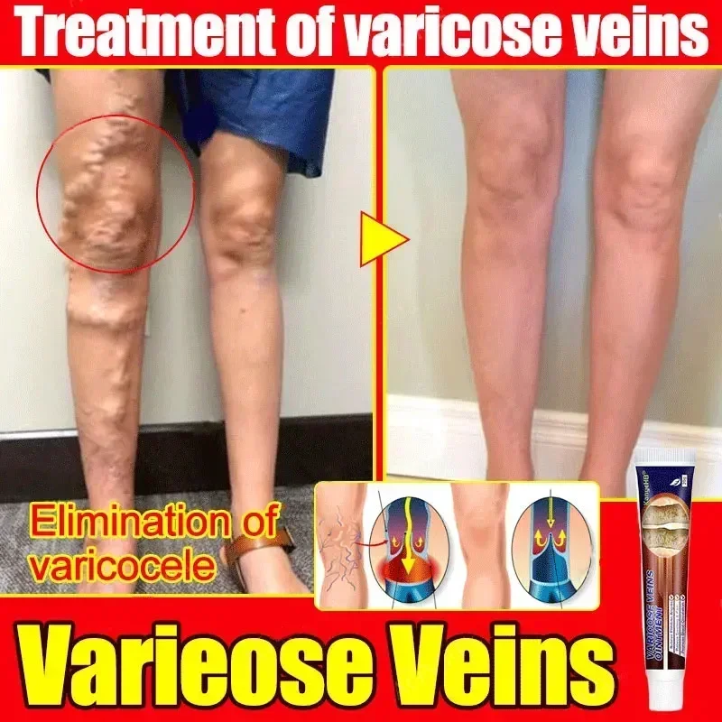 Крем против варикозного расширения вен вариесы Salep Penghilang васкутис/шиповы Tanpa Operasi