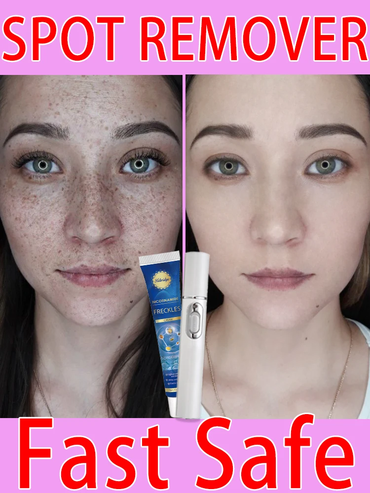 Лазерная хлоазма веснушки темный возраст солнцезащитные пятна прозрачные