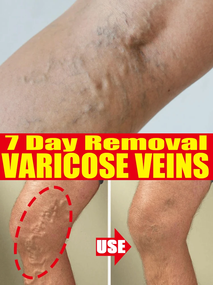 Эффективное лазерное устройство для васкулирования продукты пауков и ног